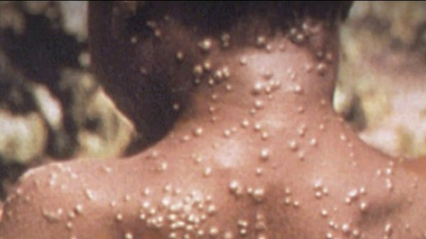 Côte d’Ivoire: Plusieurs cas de variole du singe confirmés Côte d’Ivoire: Plusieurs cas de variole du singe confirmés